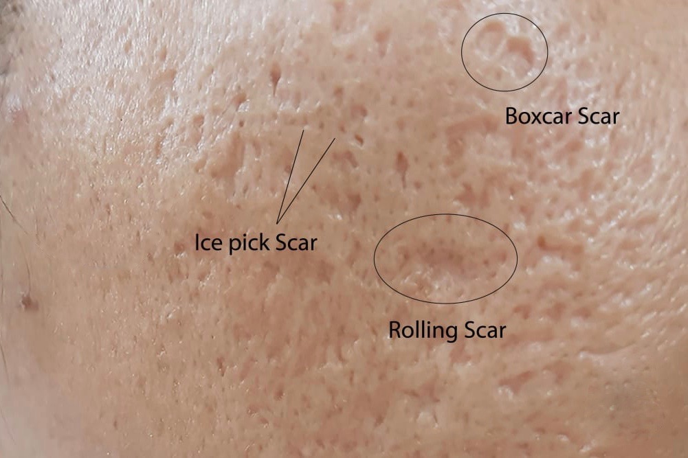 natural acne scar